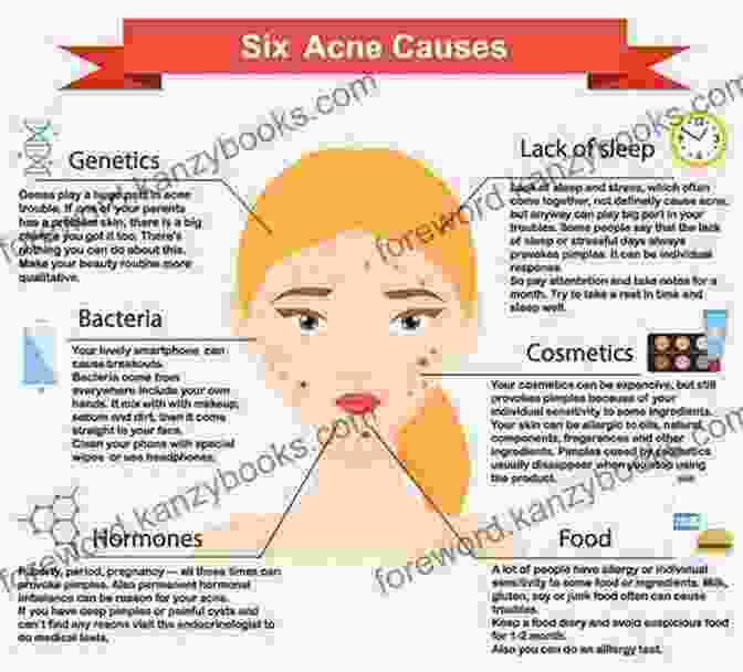 Diagram Of Acne Causes CLEANSE TO HEAL ACNE: Step By Step Guide On How To Get Rid Of Acne